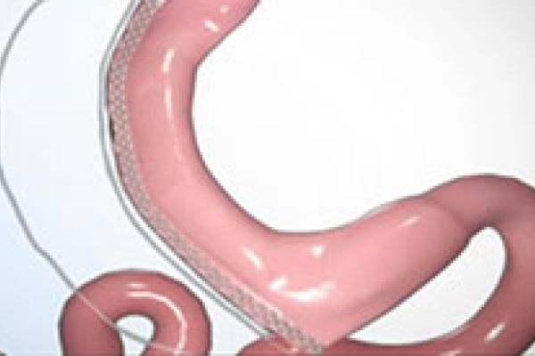 Laparoscopic Sleeve Gastrectomy